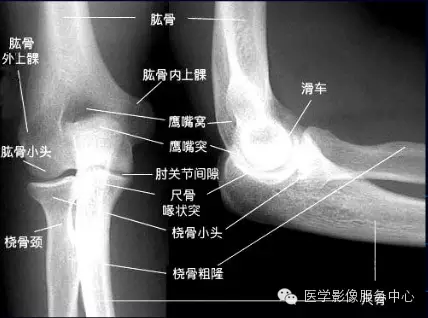 【今日征象】不要小瞧骨折的诊断--歪戴帽征及八字征