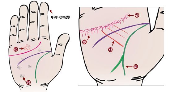 手相看病图解